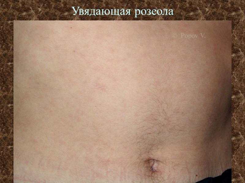 Увядающая розеола